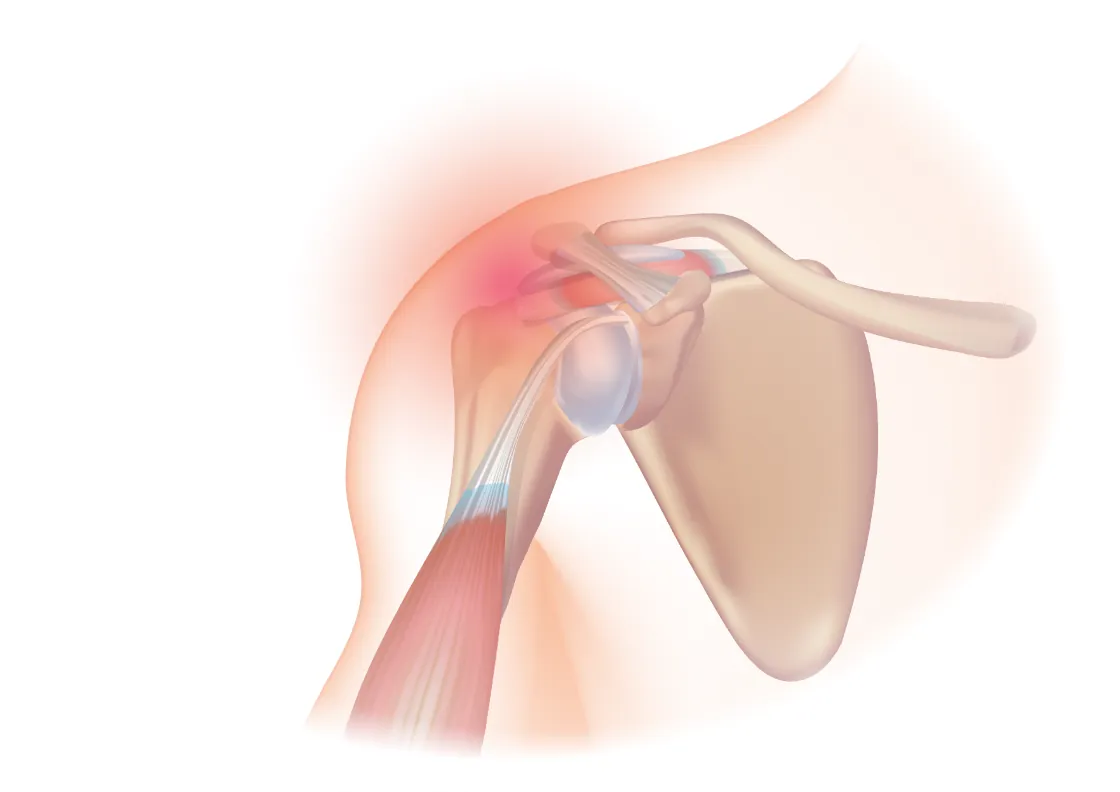 Illustration of the shoulder joint with the upper arm bone, shoulder blade, and collarbone, and a red glow at the top of the joint