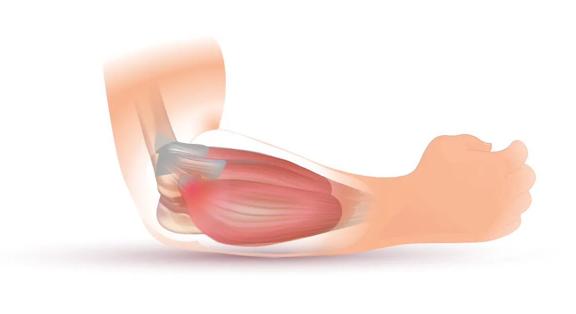 Illustration of a bent arm with the forearm muscles shown and a red spot on the outside of the elbow where tennis elbow pain sits